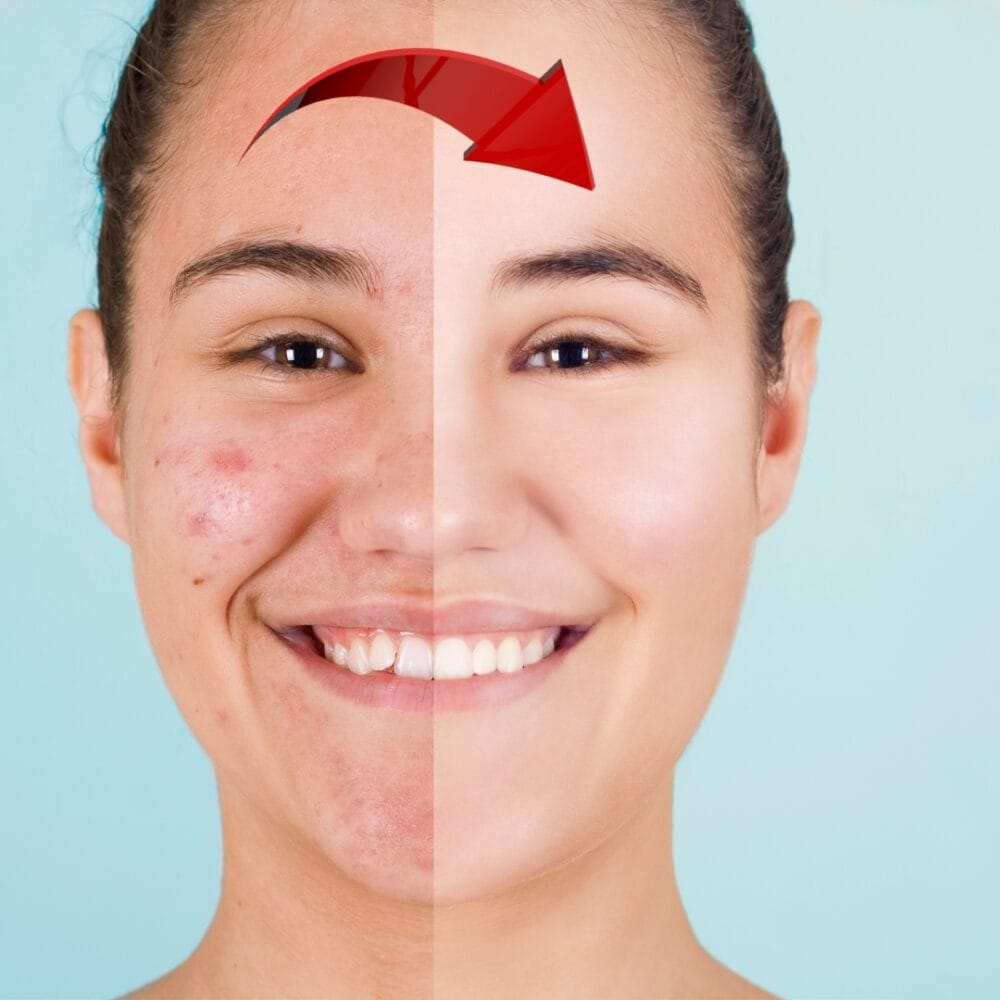 SHINING SURE Anti Acne Foaming Face Wash - Image 4